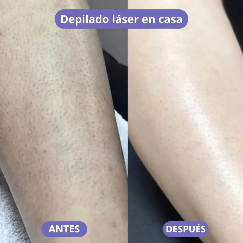 Depiladora láser D-Venus™ Quita el vello de raiz & cuida tu piel